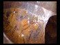 ADHESIONS BOWELS OMENTAL4 ADHESIONS BOWELS OMENTAL4